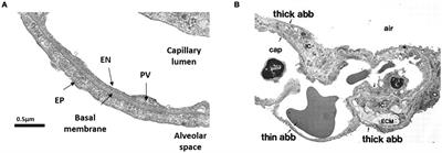 Pulmonary Interstitial Matrix and Lung Fluid Balance From Normal to the Acutely Injured Lung